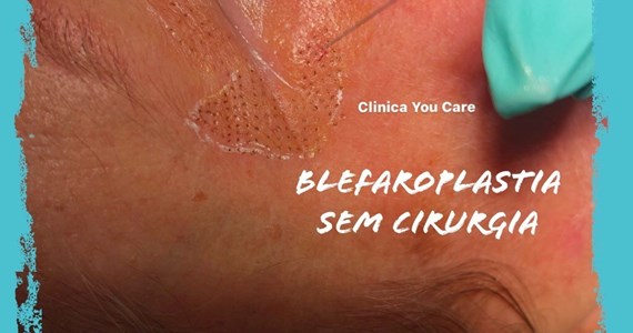 blefaroplastia