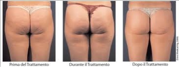 ondas_acusticas_medicas_storzmedical_celulite_flacidez_clinicaoyoucare_leiria